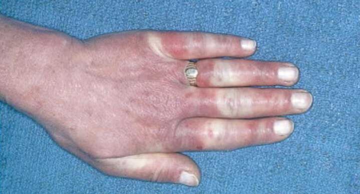 Klinický obraz Raynaudovho syndrómu - vazospazmus, hyperémia, edém