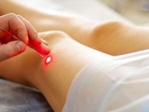 Liečba artrózy kolenného kĺbu laserom